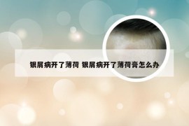 银屑病开了薄荷 银屑病开了薄荷膏怎么办