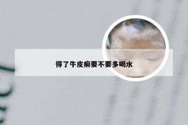 得了牛皮癣要不要多喝水