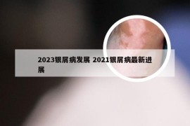 2023银屑病发展 2021银屑病最新进展