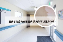 塞美尔治疗头皮银屑病 赛美尔可以涂身体吗