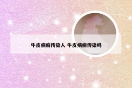 牛皮病癣传染人 牛皮病癣传染吗