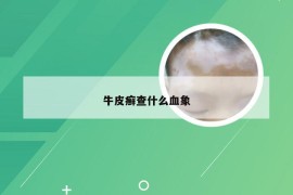 牛皮癣查什么血象
