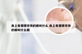 身上有像硬币块的癣叫什么 身上有像硬币块的癣叫什么癣