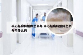 手心起癣特别痒怎么办 手心起癣特别痒怎么办用什么药