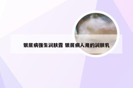 银屑病强生润肤露 银屑病人用的润肤乳