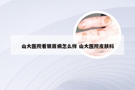 山大医院看银屑病怎么样 山大医院皮肤科