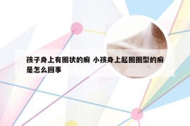 孩子身上有圈状的癣 小孩身上起圈圈型的癣是怎么回事