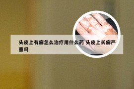 头皮上有癣怎么治疗用什么药 头皮上长癣严重吗