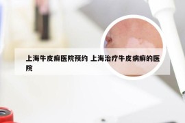 上海牛皮癣医院预约 上海治疗牛皮病癣的医院