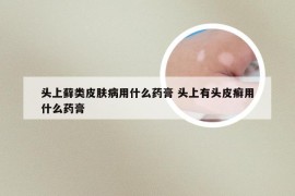 头上藓类皮肤病用什么药膏 头上有头皮癣用什么药膏