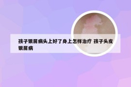 孩子银屑病头上好了身上怎样治疗 孩子头皮银屑病