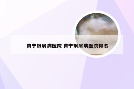 南宁银屑病医院 南宁银屑病医院排名