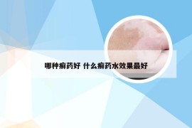 哪种癣药好 什么癣药水效果最好