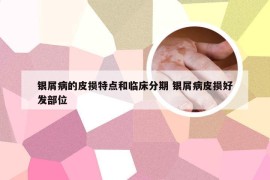 银屑病的皮损特点和临床分期 银屑病皮损好发部位