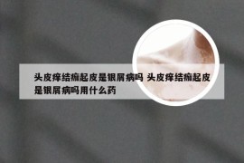 头皮痒结痂起皮是银屑病吗 头皮痒结痂起皮是银屑病吗用什么药