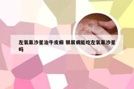 左氧氟沙星治牛皮癣 银屑病能吃左氧氟沙星吗
