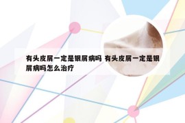 有头皮屑一定是银屑病吗 有头皮屑一定是银屑病吗怎么治疗