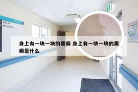身上有一块一块的黑癣 身上有一块一块的黑癣是什么