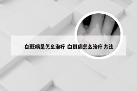 白斑病是怎么治疗 白斑病怎么治疗方法