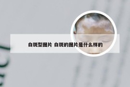 白斑型图片 白斑的图片是什么样的