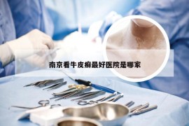南京看牛皮癣最好医院是哪家