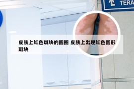 皮肤上红色斑块的圆圈 皮肤上出现红色圆形斑块