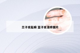 兰子皮起癣 篮子皮湿疹图片