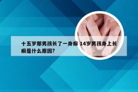 十五岁那男孩长了一身癣 14岁男孩身上长癣是什么原因?