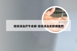 桂枝汤治疗牛皮癣 桂枝汤治皮肤病案例