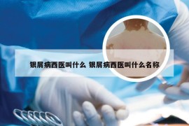 银屑病西医叫什么 银屑病西医叫什么名称