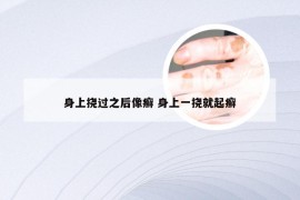 身上挠过之后像癣 身上一挠就起癣