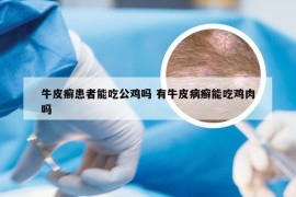牛皮癣患者能吃公鸡吗 有牛皮病癣能吃鸡肉吗