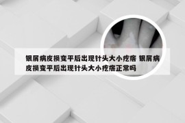 银屑病皮损变平后出现针头大小疙瘩 银屑病皮损变平后出现针头大小疙瘩正常吗