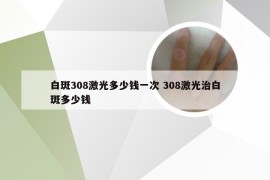 白斑308激光多少钱一次 308激光治白斑多少钱