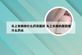 头上有癣抹什么药膏最好 头上长癣的原因用什么药水