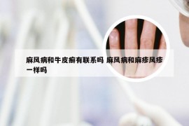 麻风病和牛皮癣有联系吗 麻风病和麻疹风疹一样吗