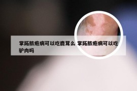 掌跖脓疱病可以吃鹿茸么 掌跖脓疱病可以吃驴肉吗