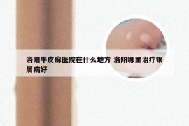 洛阳牛皮癣医院在什么地方 洛阳哪里治疗银屑病好