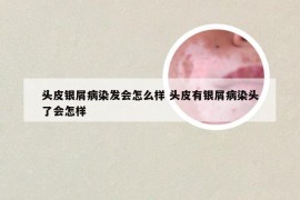 头皮银屑病染发会怎么样 头皮有银屑病染头了会怎样