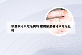 银屑病可以吃毛桃吗 银屑病患者可以吃毛肚吗