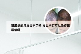 银屑病能用皮炎宁丁吗 皮炎宁酊可以治疗银屑病吗