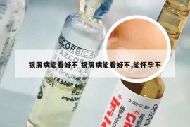 银屑病能看好不 银屑病能看好不,能怀孕不