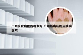 广州皮肤病医院哪家好 广州最出名的皮肤病医院