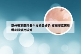 郑州哪家医院看牛皮癣最好的 郑州哪家医院看皮肤病比较好