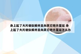 身上起了大片貌似癣并且向其它地方蔓延 身上起了大片貌似癣并且向其它地方蔓延怎么办