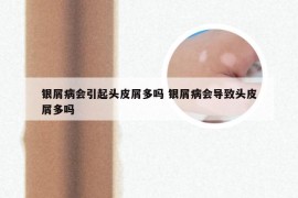 银屑病会引起头皮屑多吗 银屑病会导致头皮屑多吗