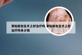 掌趾脓包在手上好治疗吗 掌趾脓包在手上好治疗吗多少钱