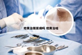 地黄治银屑病吗 地黄治啥