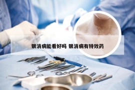 银消病能看好吗 银消病有特效药