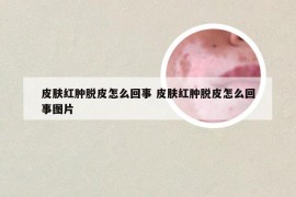 皮肤红肿脱皮怎么回事 皮肤红肿脱皮怎么回事图片